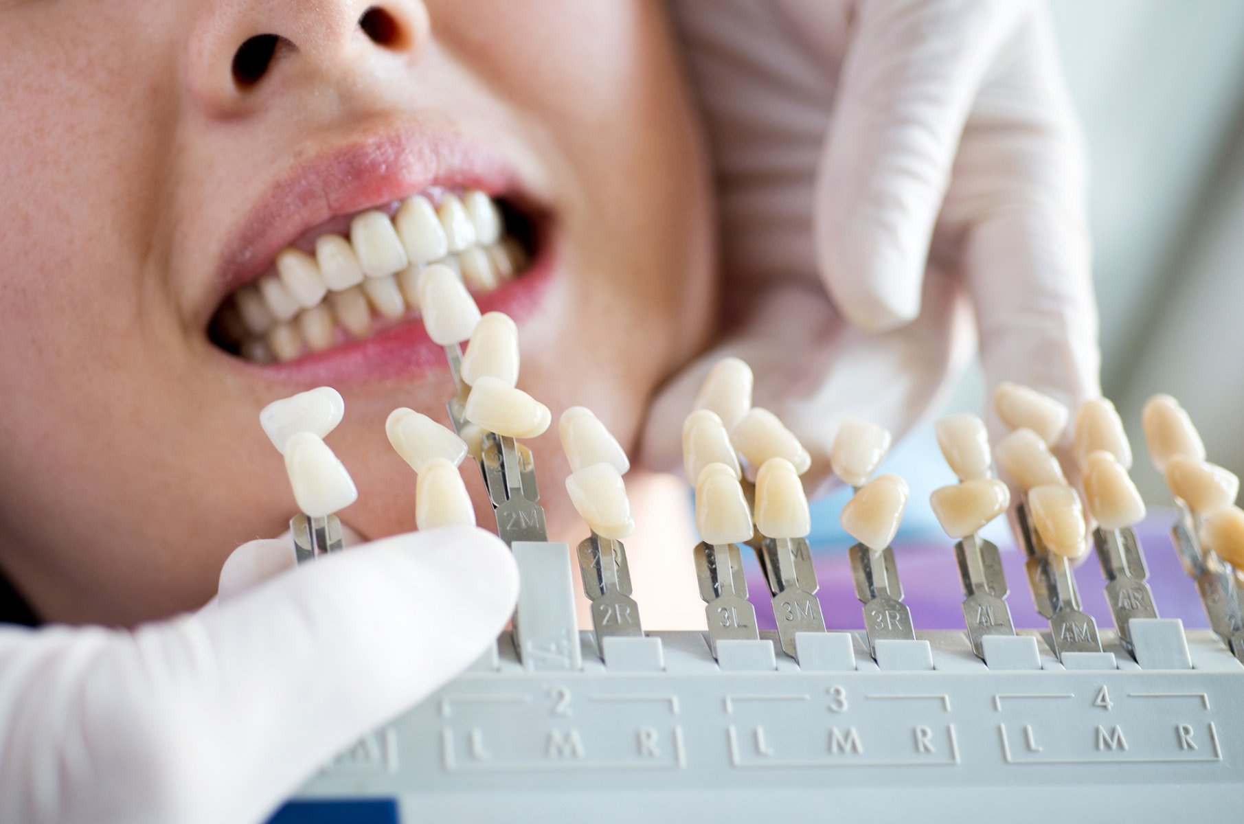 Chirurgien dentiste pour implant dentaire Marseille 8e Cabinet Maupassant